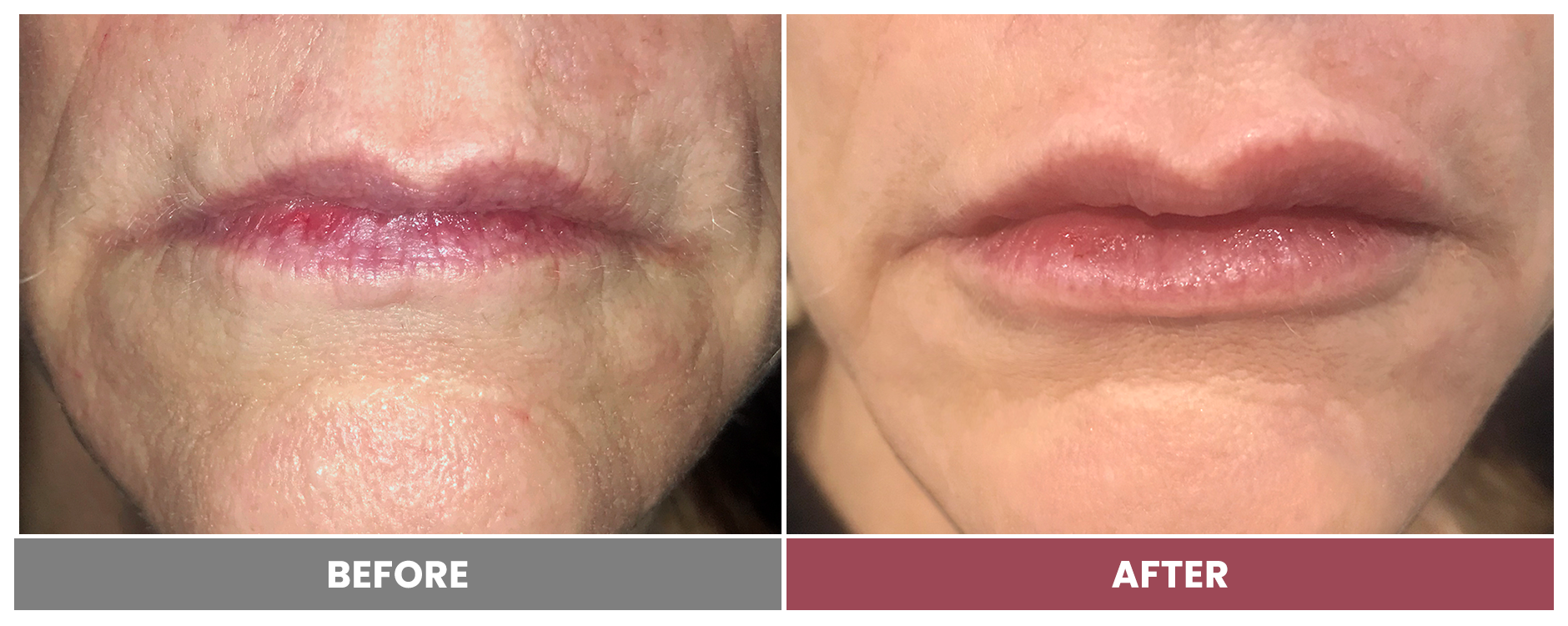 RESTYLANE - Case 5